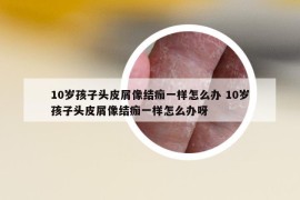 10岁孩子头皮屑像结痂一样怎么办 10岁孩子头皮屑像结痂一样怎么办呀