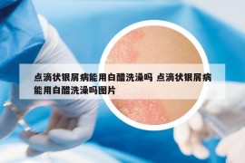 点滴状银屑病能用白醋洗澡吗 点滴状银屑病能用白醋洗澡吗图片