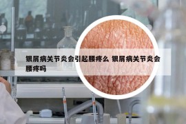 银屑病关节炎会引起腰疼么 银屑病关节炎会腰疼吗