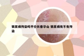 银屑病传染吗平价长春华山 银屑病有不有传染