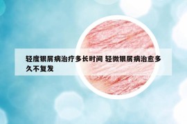 轻度银屑病治疗多长时间 轻微银屑病治愈多久不复发