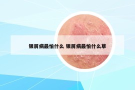 银屑病最怕什么 银屑病最怕什么草