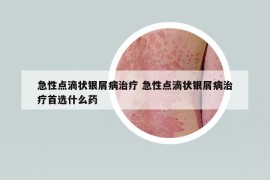 急性点滴状银屑病治疗 急性点滴状银屑病治疗首选什么药