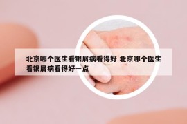 北京哪个医生看银屑病看得好 北京哪个医生看银屑病看得好一点