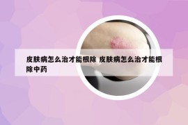 皮肤病怎么治才能根除 皮肤病怎么治才能根除中药