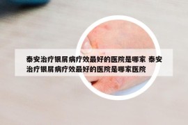 泰安治疗银屑病疗效最好的医院是哪家 泰安治疗银屑病疗效最好的医院是哪家医院