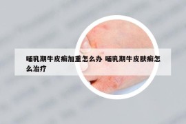 哺乳期牛皮癣加重怎么办 哺乳期牛皮肤癣怎么治疗