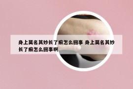 身上莫名其妙长了癣怎么回事 身上莫名其妙长了癣怎么回事啊