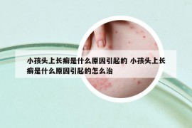 小孩头上长癣是什么原因引起的 小孩头上长癣是什么原因引起的怎么治