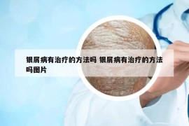 银屑病有治疗的方法吗 银屑病有治疗的方法吗图片