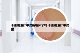 干细胞治疗牛皮癣临床了吗 干细胞治疗牛皮廨