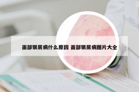 面部银屑病什么原因 面部银屑病图片大全