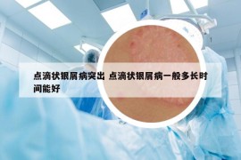 点滴状银屑病突出 点滴状银屑病一般多长时间能好