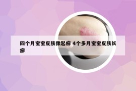 四个月宝宝皮肤像起癣 4个多月宝宝皮肤长癣