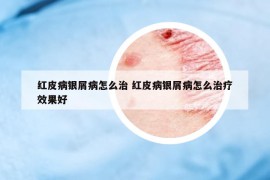 红皮病银屑病怎么治 红皮病银屑病怎么治疗效果好