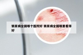 银屑病全国哪个医院好 银屑病全国哪里看得好