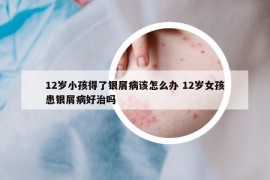 12岁小孩得了银屑病该怎么办 12岁女孩患银屑病好治吗