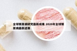 全球银屑病研究最新成果 2020年全球银屑病最新进展