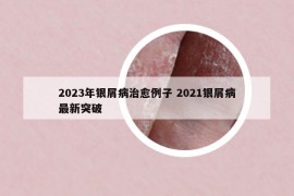 2023年银屑病治愈例子 2021银屑病最新突破