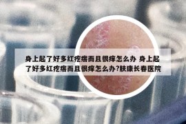 身上起了好多红疙瘩而且很痒怎么办 身上起了好多红疙瘩而且很痒怎么办?肤康长春医院