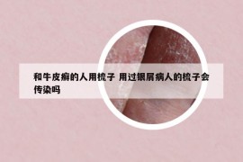 和牛皮癣的人用梳子 用过银屑病人的梳子会传染吗