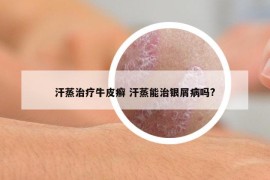 汗蒸治疗牛皮癣 汗蒸能治银屑病吗?