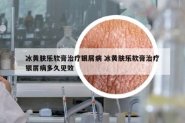 冰黄肤乐软膏治疗银屑病 冰黄肤乐软膏治疗银屑病多久见效