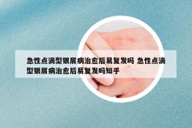 急性点滴型银屑病治愈后易复发吗 急性点滴型银屑病治愈后易复发吗知乎