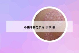 小孩子藓怎么治 小孩 癣