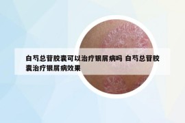 白芍总苷胶囊可以治疗银屑病吗 白芍总苷胶囊治疗银屑病效果