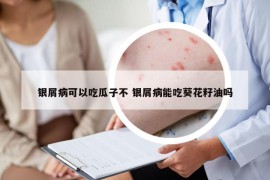 银屑病可以吃瓜子不 银屑病能吃葵花籽油吗