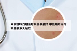 甲氨蝶呤口服治疗银屑病最好 甲氨蝶呤治疗银屑病多久起效