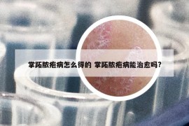 掌跖脓疱病怎么得的 掌跖脓疱病能治愈吗?