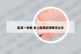 起洛一身癣 身上起癣还痒痒怎么办