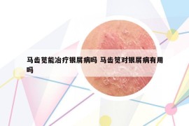 马齿苋能冶疗银屑病吗 马齿笕对银屑病有用吗