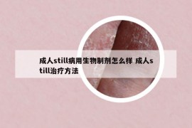 成人still病用生物制剂怎么样 成人still治疗方法