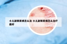 小儿副银屑病怎么治 小儿副银屑病怎么治疗最好