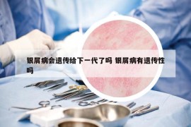 银屑病会遗传给下一代了吗 银屑病有遗传性吗