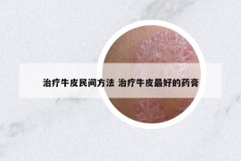 治疗牛皮民间方法 治疗牛皮最好的药膏