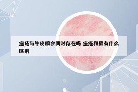 痤疮与牛皮癣会同时存在吗 痤疮和藓有什么区别