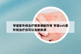 窄谱紫外线治疗银屑病副作用 窄谱uvb紫外线治疗仪可以治银屑病