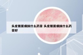 头皮银屑病抹什么药膏 头皮银屑病抹什么药膏好