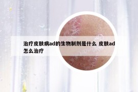 治疗皮肤病ad的生物制剂是什么 皮肤ad怎么治疗