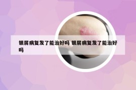 银屑病复发了能治好吗 银屑病复发了能治好吗