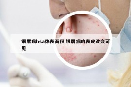 银屑病bsa体表面积 银屑病的表皮改变可见