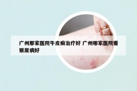 广州那家医院牛皮癣治疗好 广州哪家医院看银屑病好