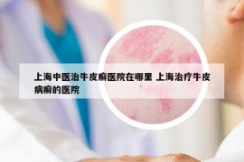 上海中医治牛皮癣医院在哪里 上海治疗牛皮病癣的医院