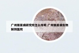 广州银屑病研究院怎么样呢 广州银屑病生物制剂医院