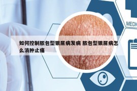 如何控制脓包型银屑病发病 脓包型银屑病怎么消肿止痛