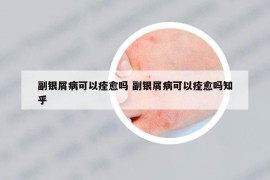 副银屑病可以痊愈吗 副银屑病可以痊愈吗知乎